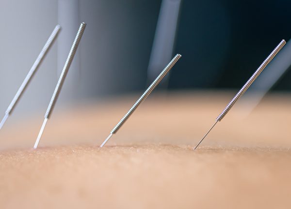 Mange får akupunktur imod menstruations smerter